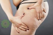 ¿Qué es el Lipedema?