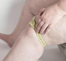 Tratamiento de Lipedema