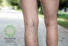 Insuficiencia Venosa Crónica y Edema