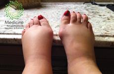 Cuidados en Linfedema