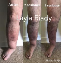 Tratamiento de linfedema después de 9 sesiones de terapia descongestiona completa con drenaje linfático Vodder