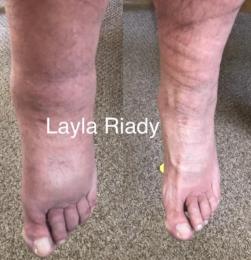 Tratamiento de linfedema después de 1 sesión de terapia descongestiona completa con drenaje linfático Vodder