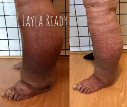 Después de 3 sesiones de 1 hora de duración de terapia descongestiva compleja